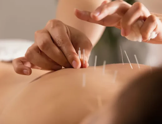 Acupuncture