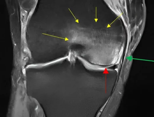 Bone Marrow Edema (BME) Rehabilitation