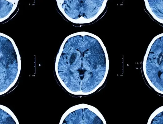 Stroke Rehabilitation