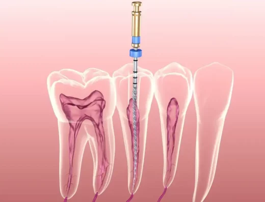 Endodontic Treatment