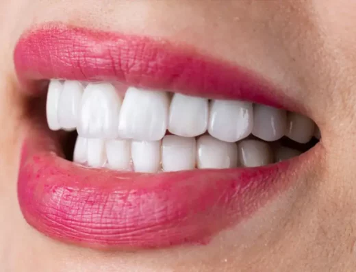 Veneers