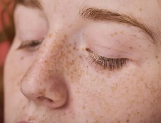 Freckles – Acne Scars Treatment