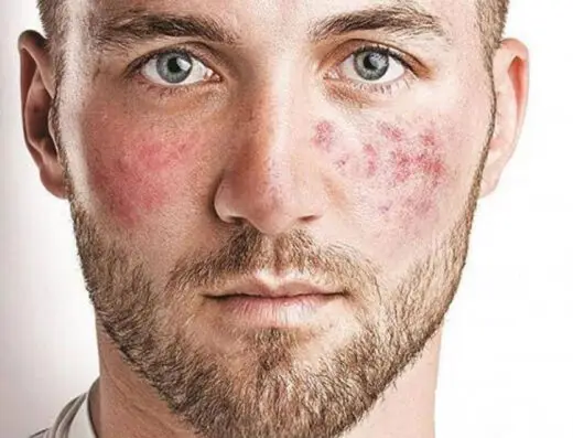 Rosacea Treatment