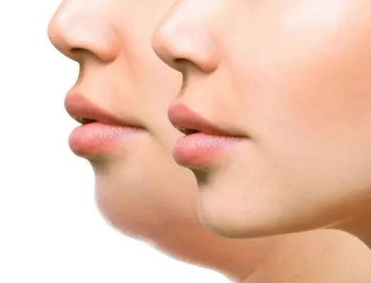 Double Chin Lipolysis