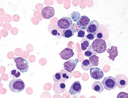 Myelodysplastic Syndrome (MDS) Diagnosis