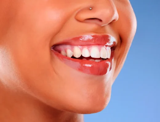 Teeth Whitening and Veneers Application