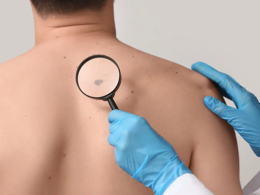 Dermoscopy – Skin Cancer Prevention